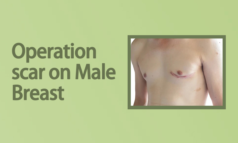 Scar Revision Gynecomastia in Surat