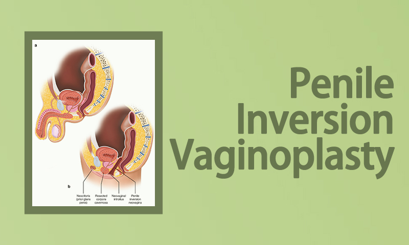 Penile Inversion Vaginoplasty