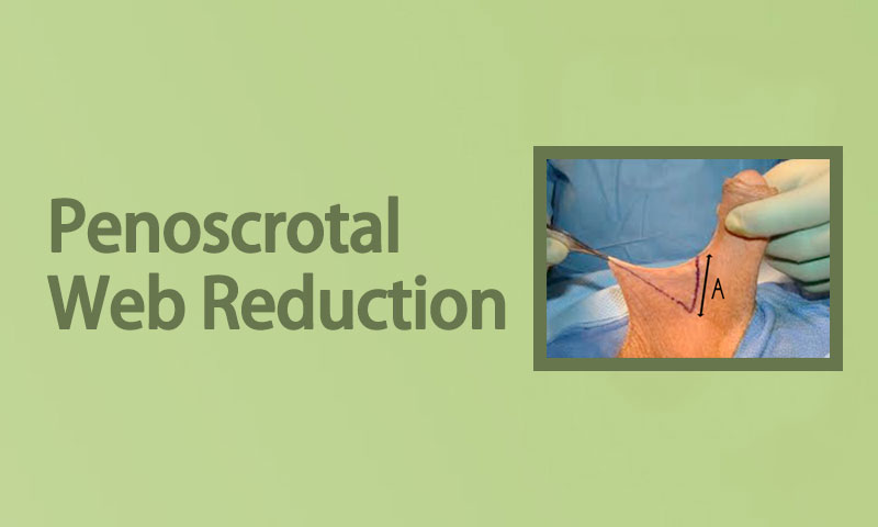 Penoscrotal Web Reduction Surgery in Surat, Gujarat (India)