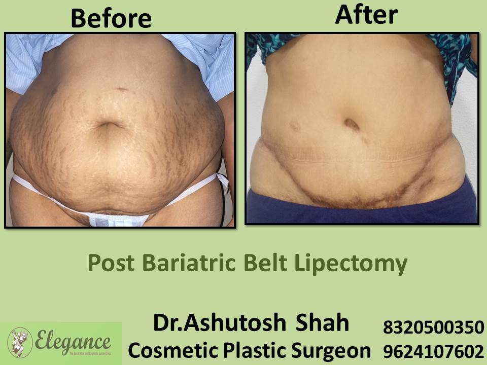 When Can You  Do Post Bariatric Treatment in Body