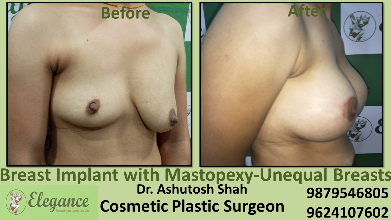 Mastopexy With Implants