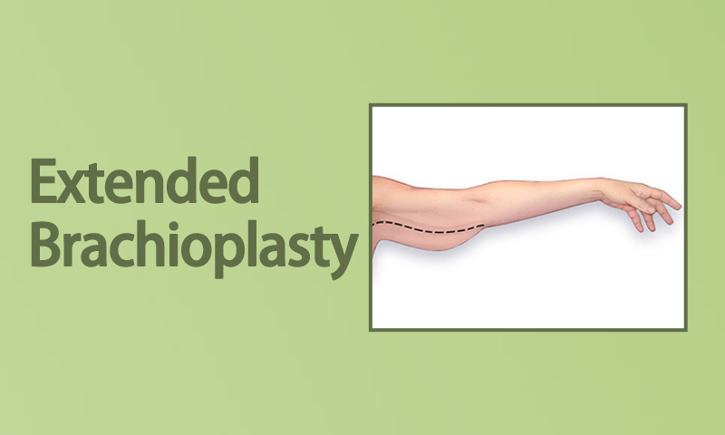 Extended Brachioplasty