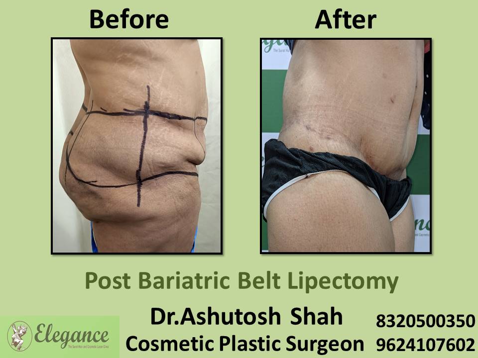 Why Do You Need Post Bariatric Cosmetic Surgery