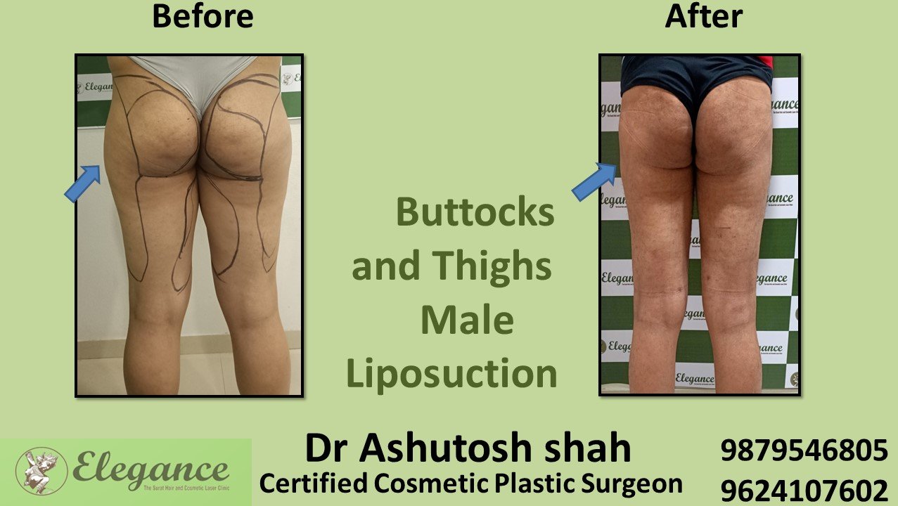 Combination Thigh Lift