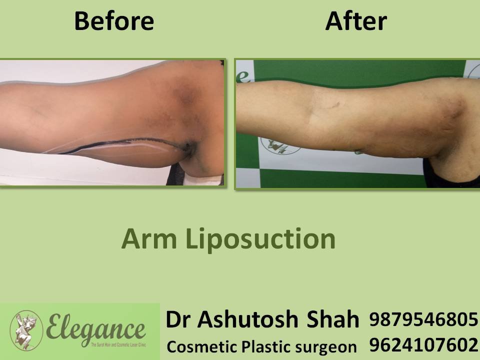 Extended Brachioplasty