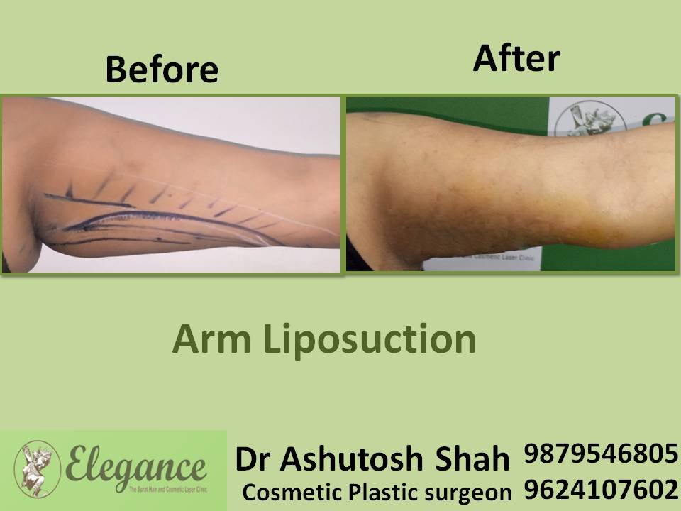 Extended Brachioplasty