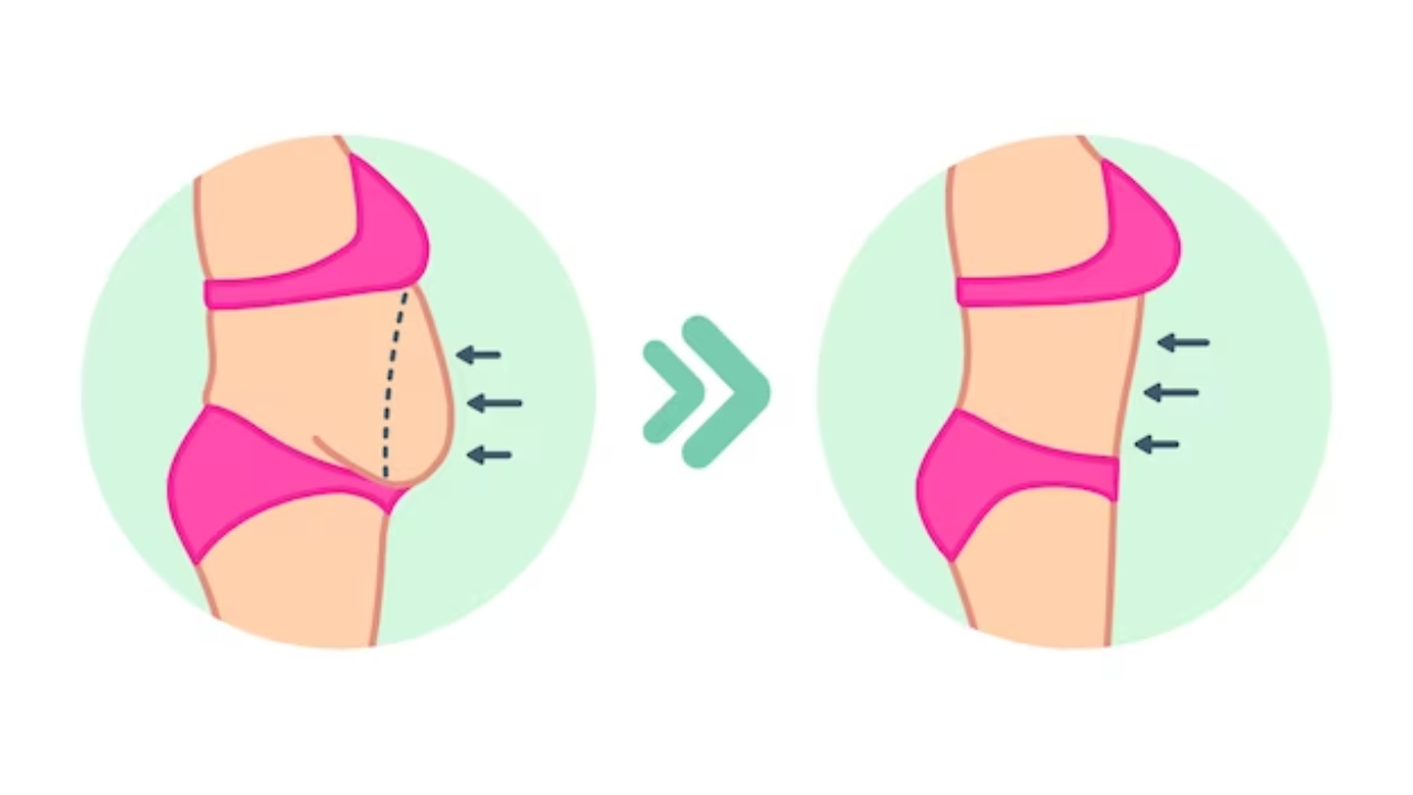 Tummy Tuck