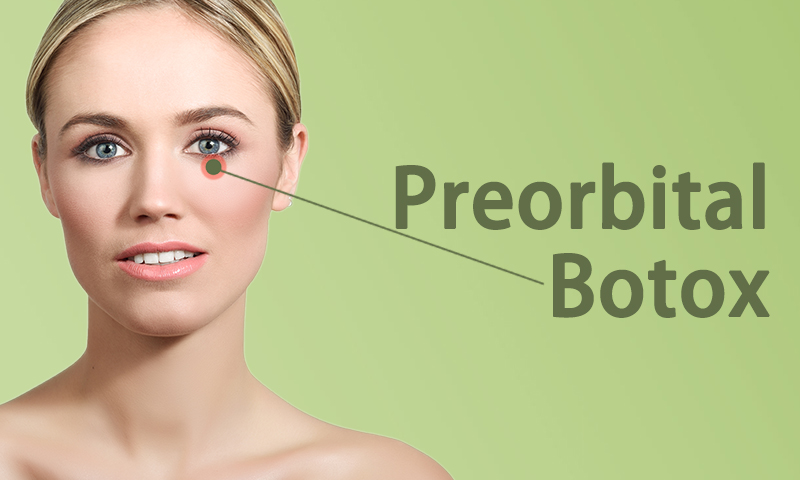 Preorbital Botox Treatment in Surat, Gujarat (India)