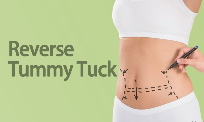 Reverse Tummy Tuck