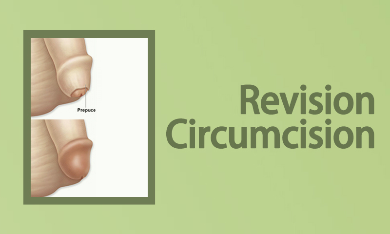 Revision Circumcision Surgery in Surat (Gujarat) India