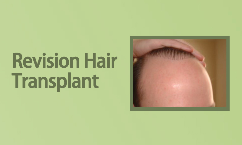 Revision Hair Transplant