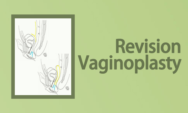 Revision Vaginoplasty