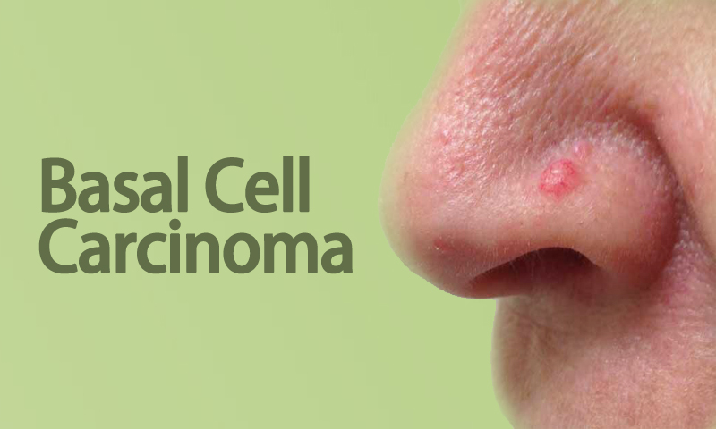 Basal Cell Carcinoma