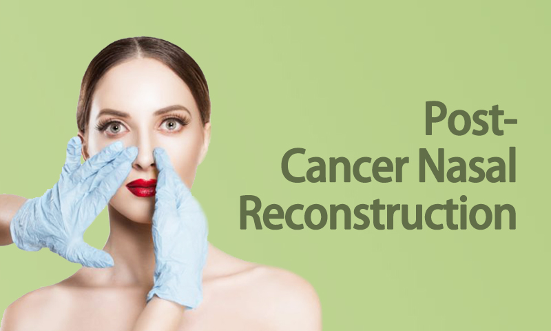 Post-Cancer Nasal Reconstruction