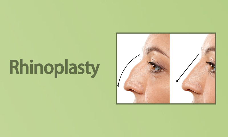 Rhinoplasty