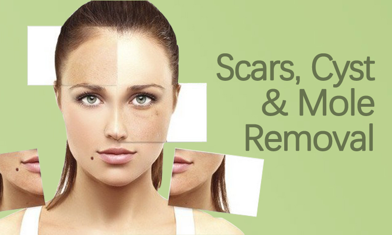 Scars, Cyst & Mole Removal in Surat, Gujarat (India)