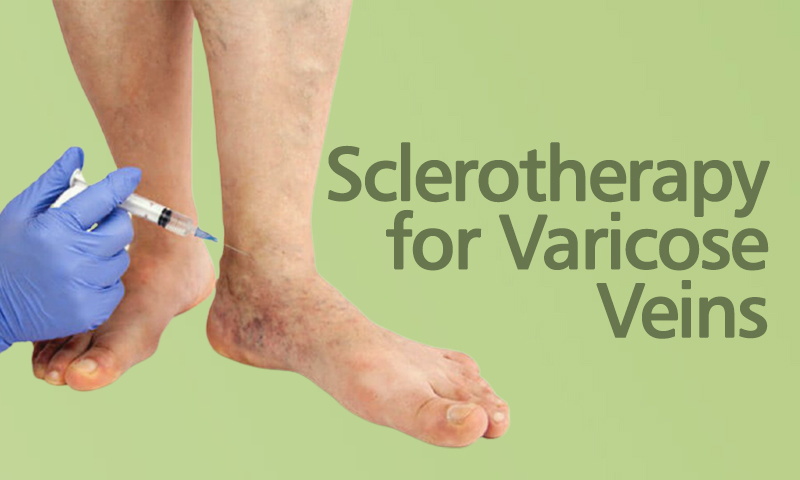 Sclerotherapy For Varicose Veins