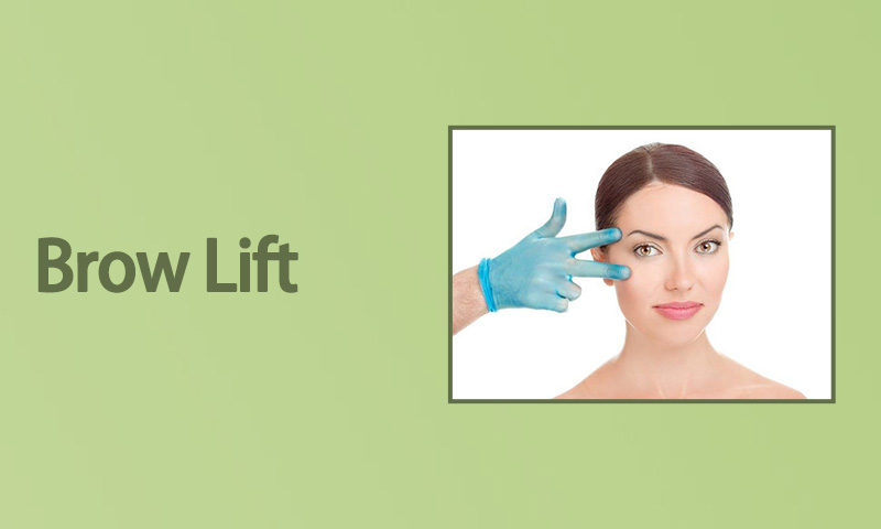 Brow Lift