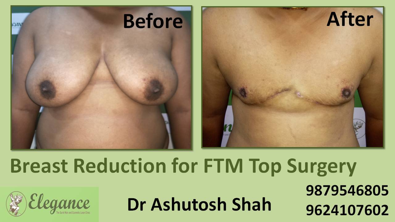 Transgender Female To Male Top Surgery