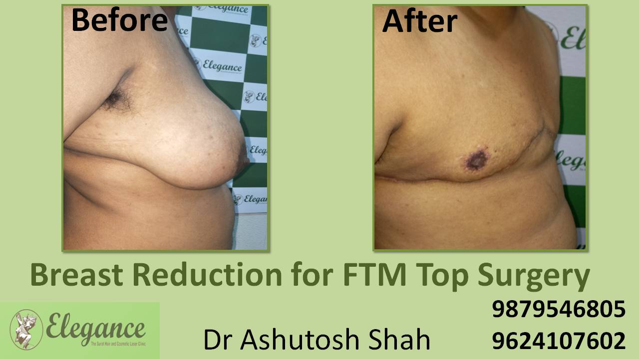 FTM Top Surgery