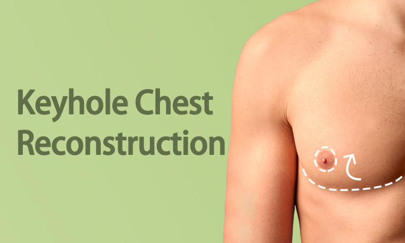 Keyhole Chest Reconstruction