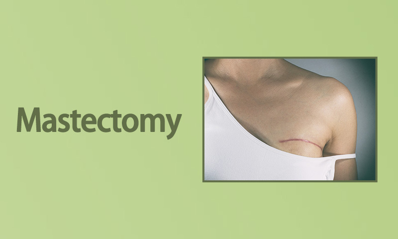 Mastectomy