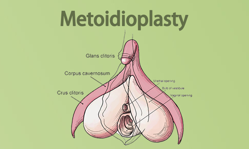 Metoidioplasty