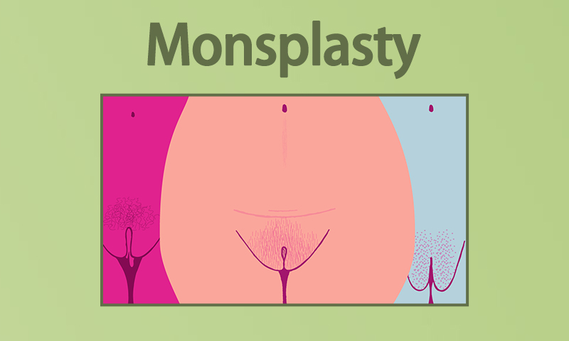 Monsplasty