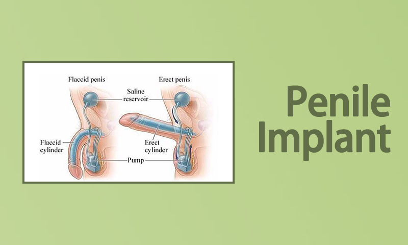 Penile Implant