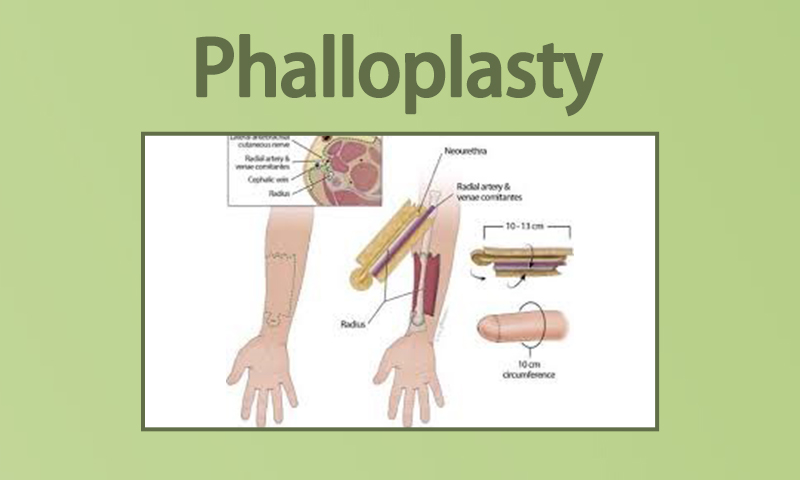 Phalloplasty