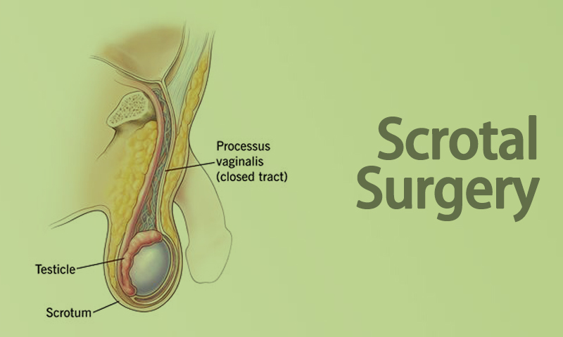 Scrotal Surgery
