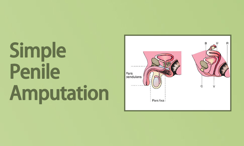 Simple Penile Amputation