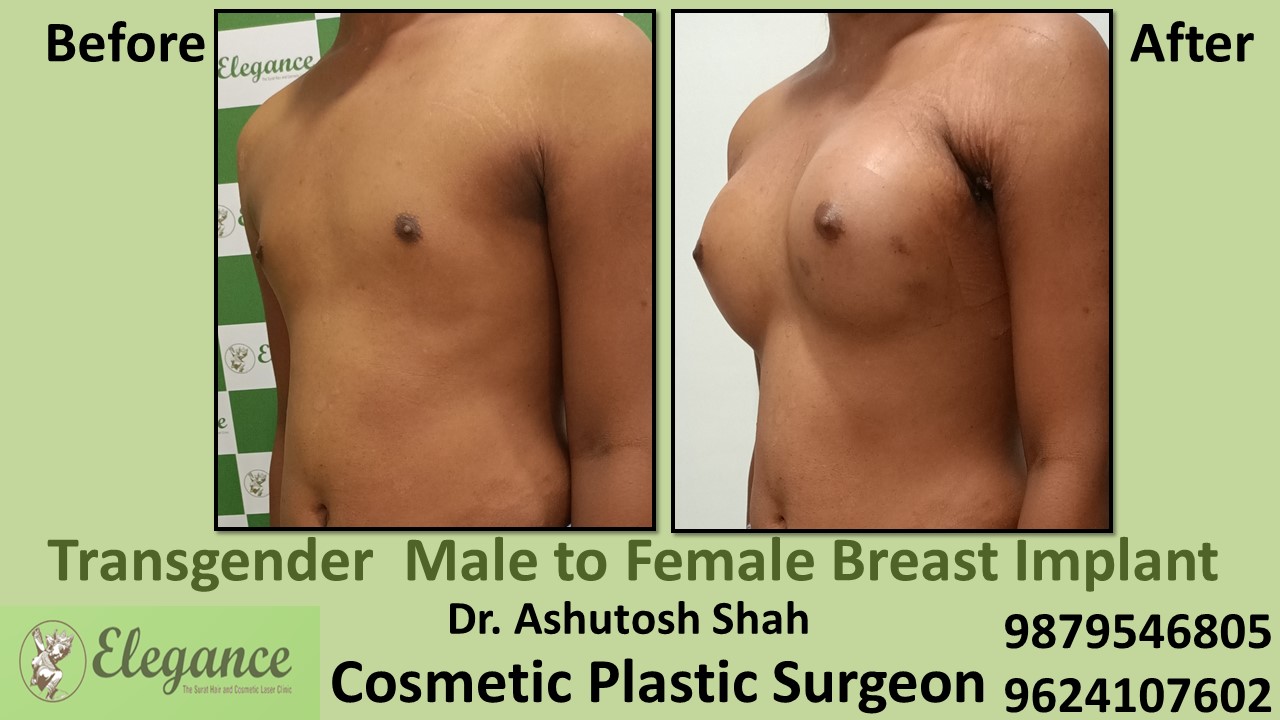 Transgender Male To Female Top Surgery