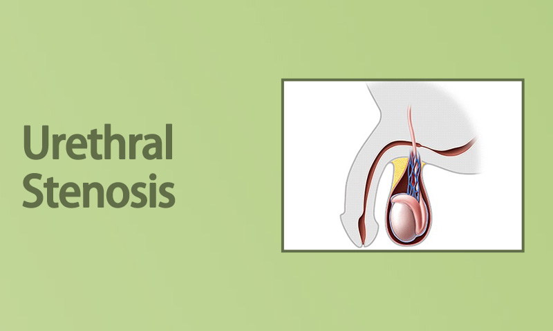 Urethral Stenosis
