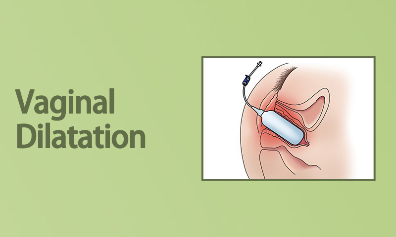 Vaginal Dilatation