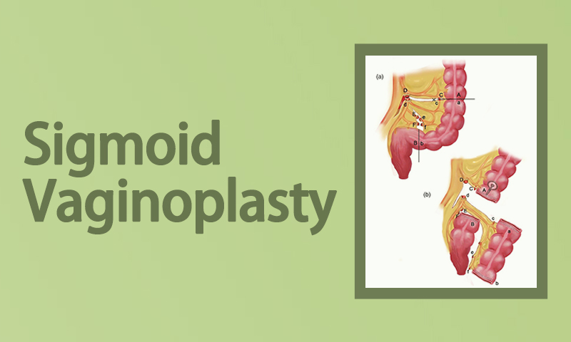 Sigmoid Vaginoplasty