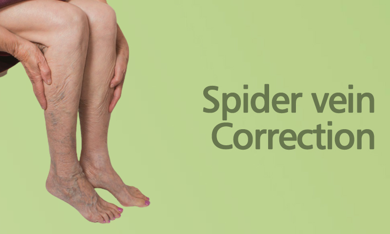 Spider Vein Correction