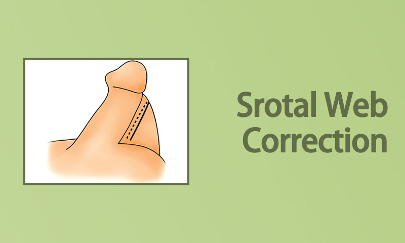 Scrotal Web Correction