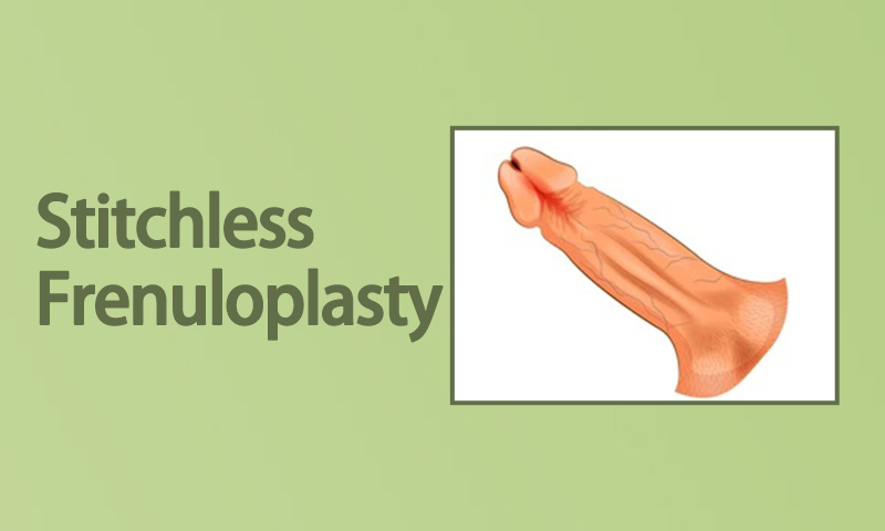 Stitchless Frenuloplasty