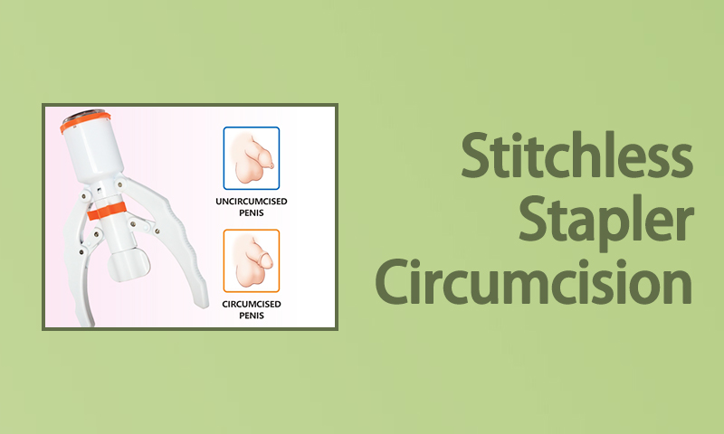 Stitchless Stapler Circumcision