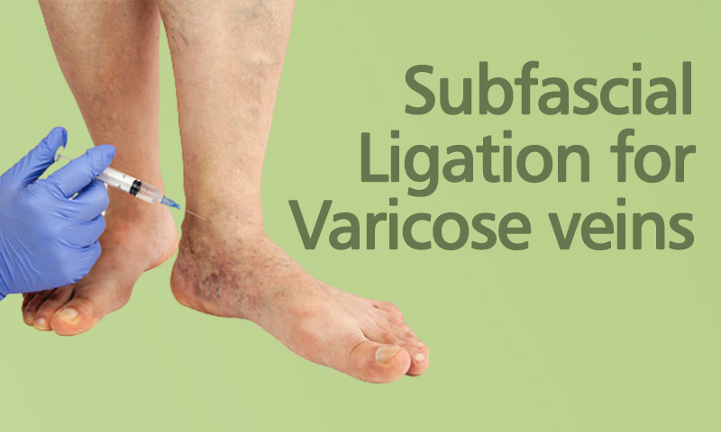 Subfascial Ligation For Varicose Veins