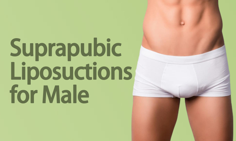 Suprapubic Liposuctions For Male