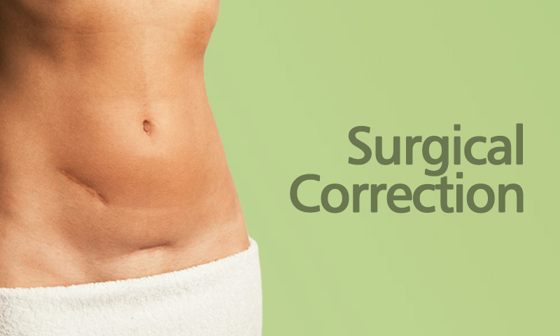 Surgical Correction