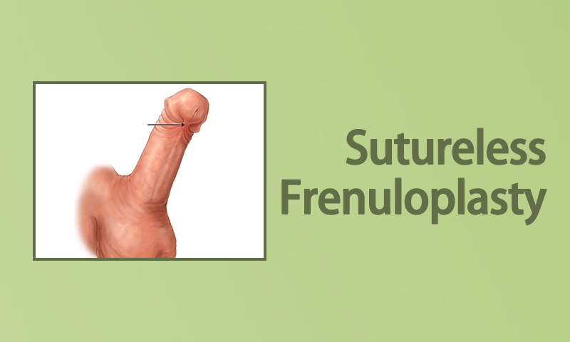 Sutureless Frenuloplasty
