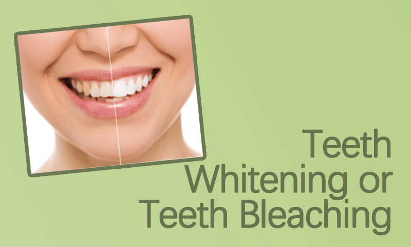 Teeth Whitening Treatment, Teeth Bleaching Treatment in Surat, Gujarat (India)