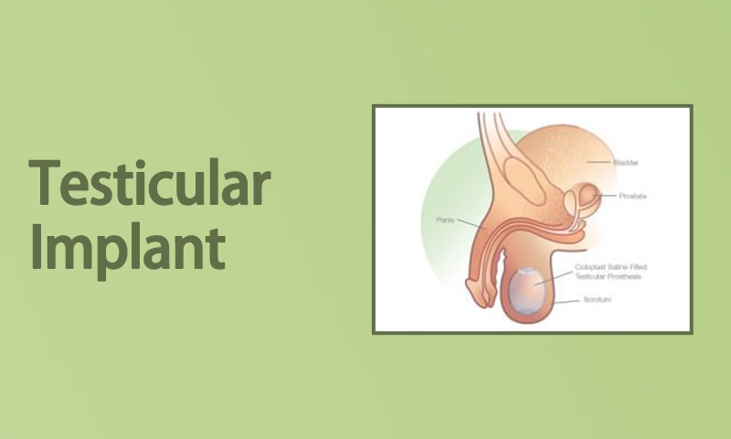 Testicular Implant
