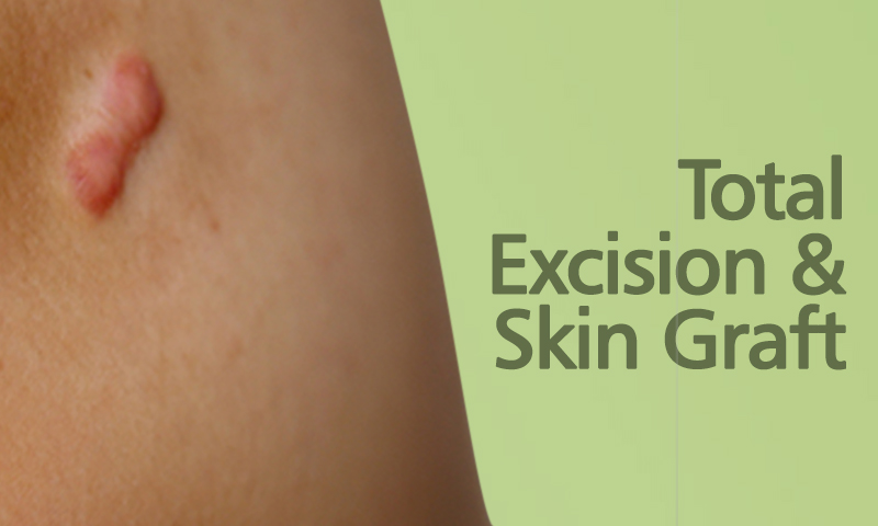 Total Excision And Skin Graft