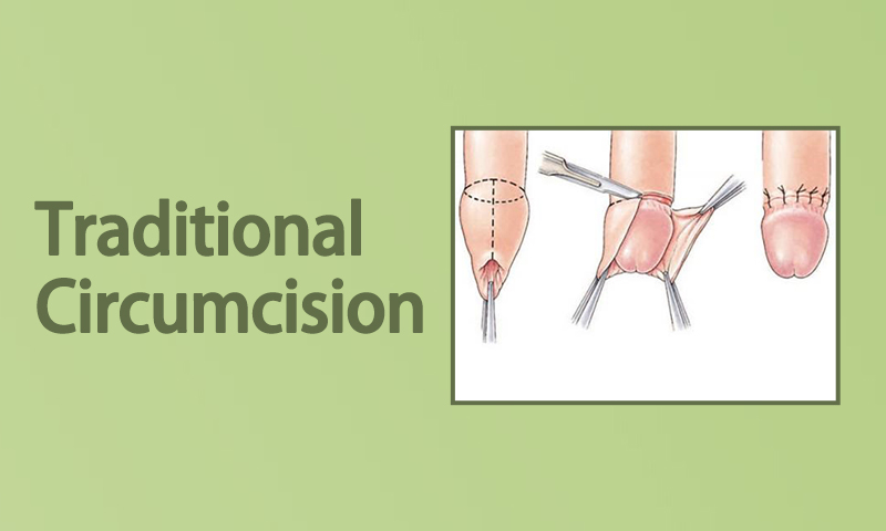 Traditional Circumcision