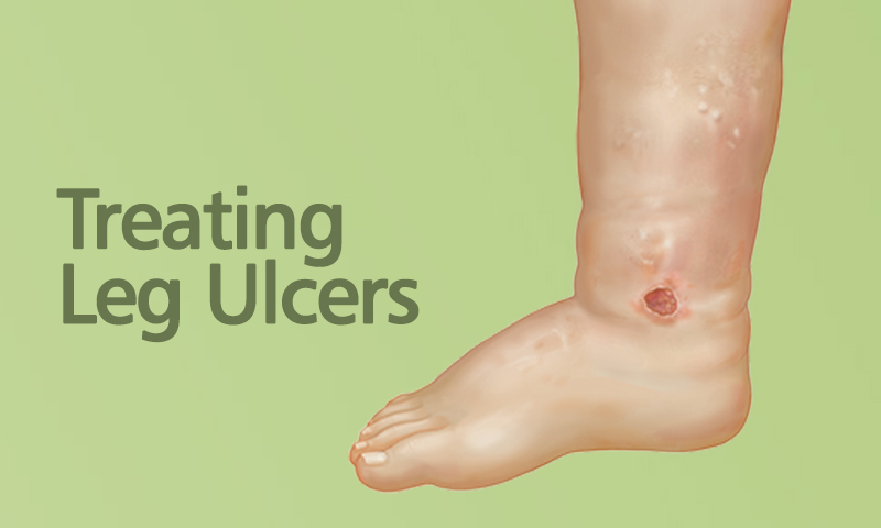 Treating Leg Ulcers