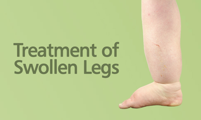 Treatment of Swollen Legs